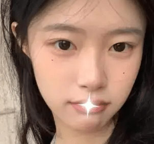 雙眼皮失敗修復(fù) 雙眼皮失敗修復(fù)