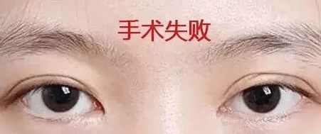 雙眼皮失敗 雙眼皮失敗