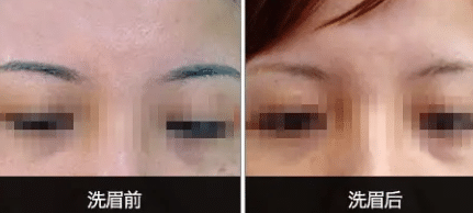 激光洗眉前后對比
