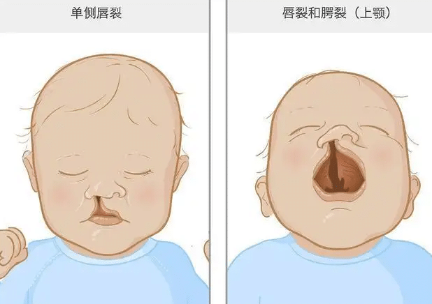 唇裂手術(shù) 唇裂手術(shù)