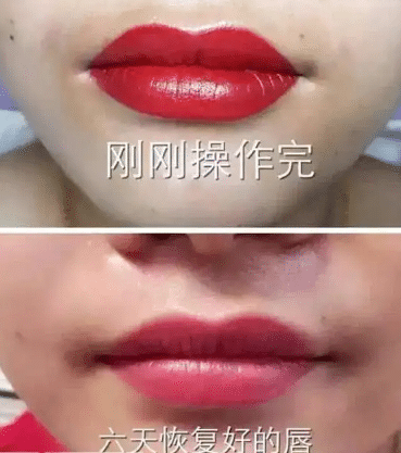 漂唇恢復對比