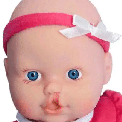 唇腭裂 唇腭裂