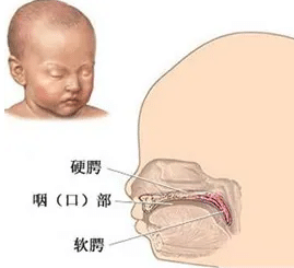 唇腭裂 唇腭裂
