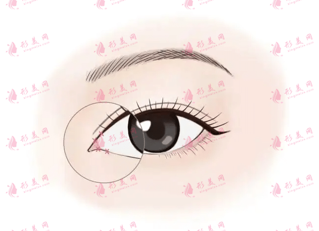 開(kāi)內(nèi)眼角的副作用有哪些?在哪開(kāi)眼角比較好?