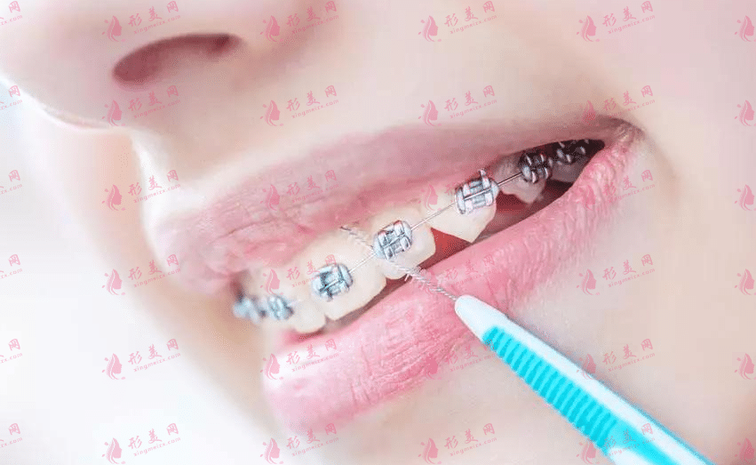 牙套 牙套