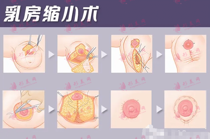 幾歲可以做乳房縮小手術(shù)? 幾歲可以做乳房縮小手術(shù)?