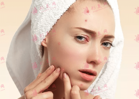 左臉頰長痘