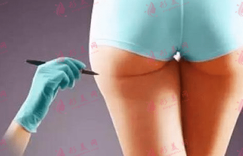 大腿吸脂 大腿吸脂