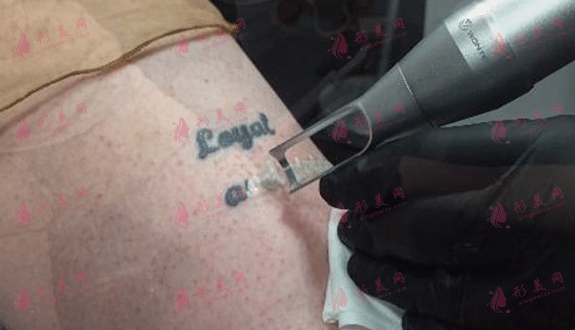 激光洗紋身 激光洗紋身