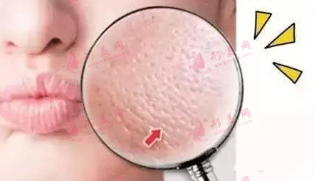 毛孔堵塞 毛孔堵塞