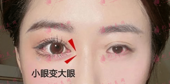 開眼角拆線后洗臉需要注意什么? 開眼角拆線后洗臉需要注意什么?