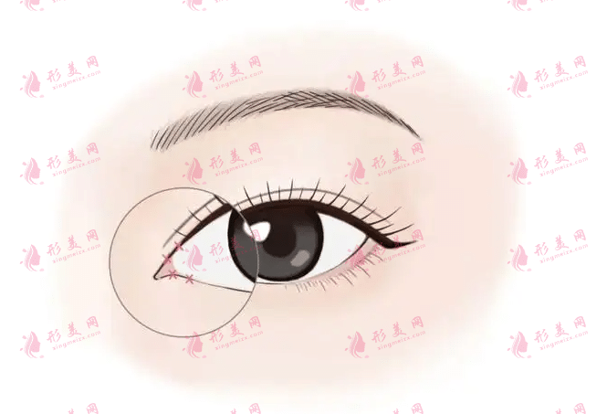 開眼角術(shù)后怎么護理? 開眼角術(shù)后怎么護理?