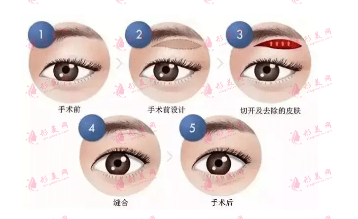 切眉術(shù)有哪些？