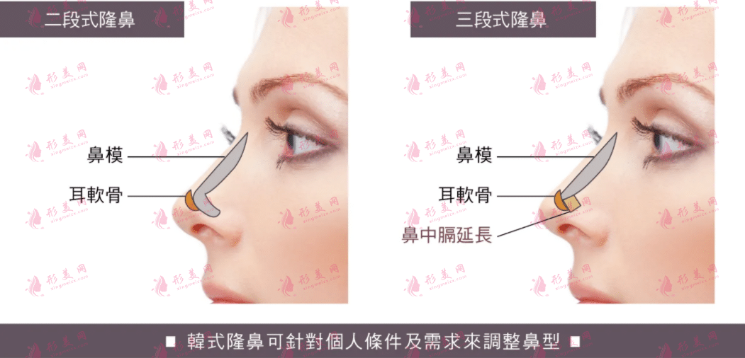 耳軟骨隆鼻會被吸收嗎? 耳軟骨隆鼻會被吸收嗎?