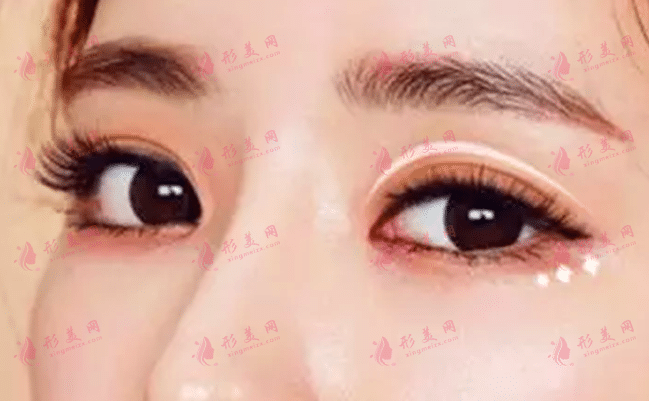 雙眼皮 雙眼皮
