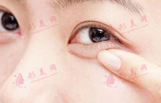 玻尿酸臥蠶填充 玻尿酸臥蠶填充