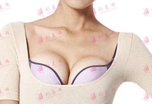 假體隆胸 假體隆胸