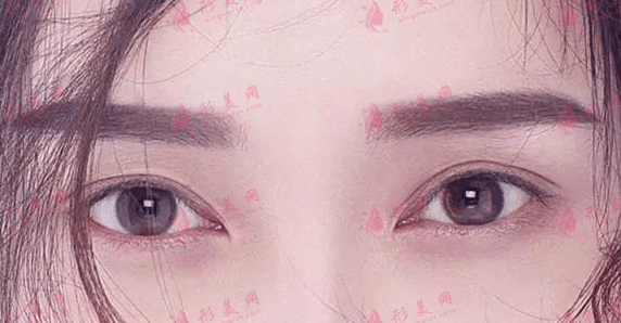 雙眼皮修復(fù) 雙眼皮修復(fù)