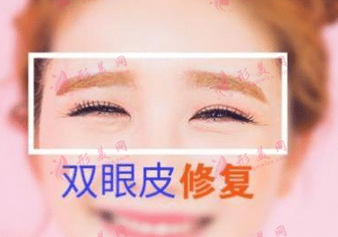 雙眼皮修復(fù) 雙眼皮修復(fù)