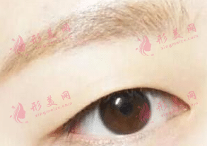 單眼皮 單眼皮