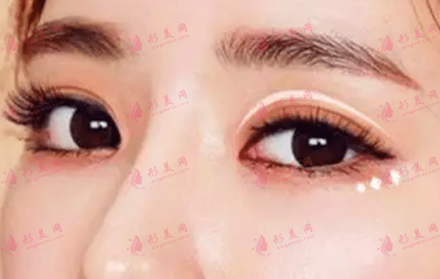 雙眼皮 雙眼皮