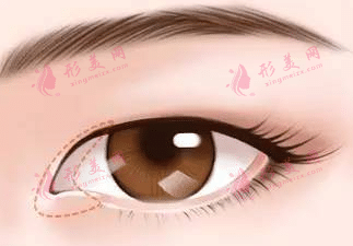 內(nèi)眼角 內(nèi)眼角