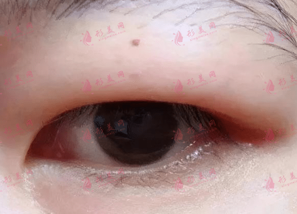 腫泡眼
