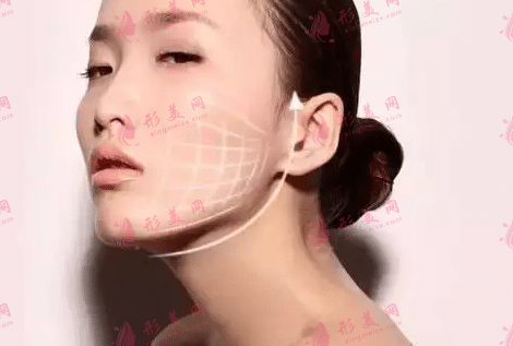 埋線提升 埋線提升