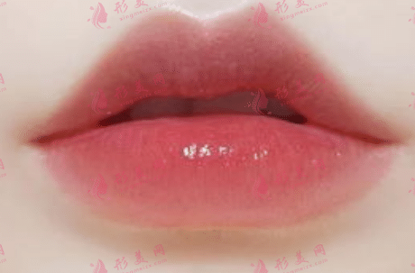 嘟嘟唇能維持多久？玻尿酸豐唇的維持時(shí)間