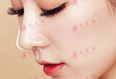 隆鼻 隆鼻