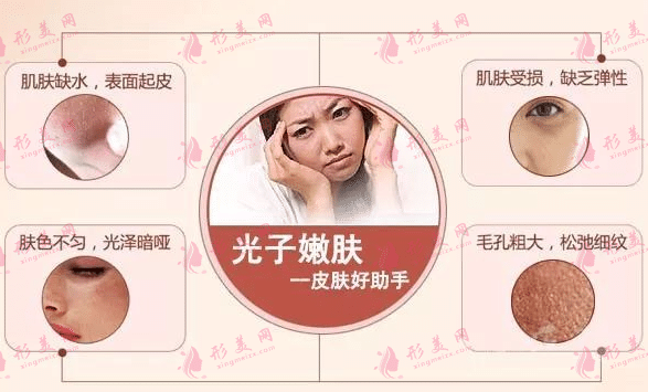光子嫩膚 光子嫩膚