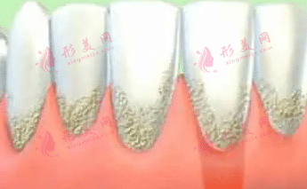 牙齦萎縮 牙齦萎縮