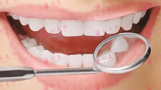 牙齒治療 牙齒治療
