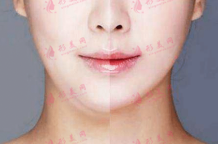 面部吸脂對比 面部吸脂對比