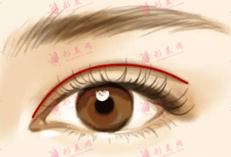 雙眼皮手術(shù) 雙眼皮手術(shù)