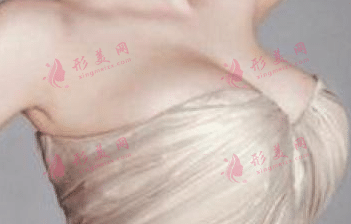 硅膠隆胸