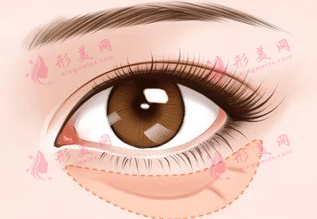 眶隔釋放釋放法 眶隔釋放釋放法