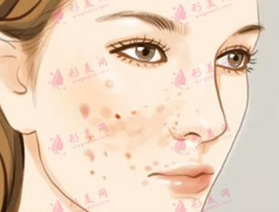 激光點(diǎn)痣