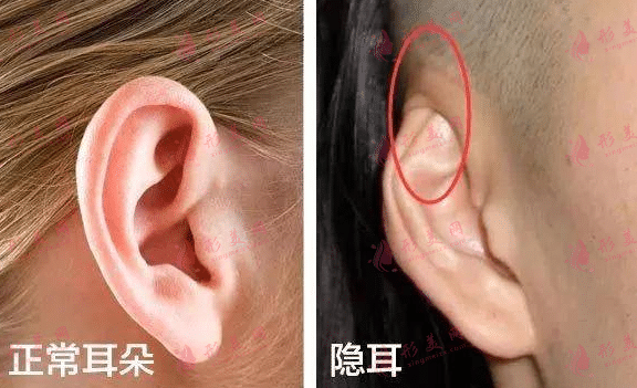 隱耳 隱耳