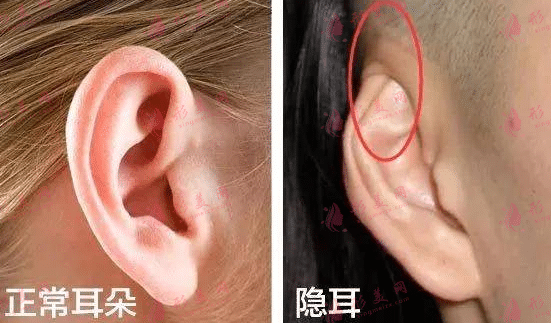 正常耳朵和隱耳的區(qū)別 正常耳朵和隱耳的區(qū)別