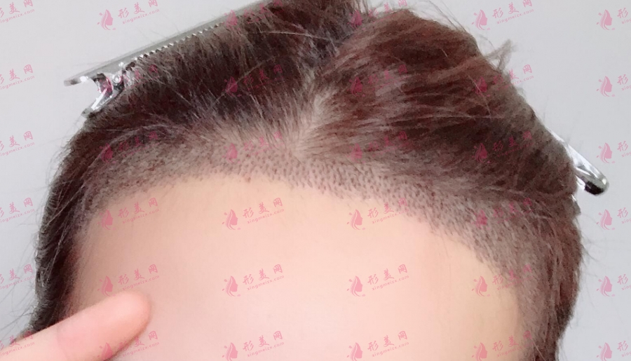 發(fā)際線(xiàn)調(diào)整后可能會(huì)出現(xiàn)的四種后遺癥！