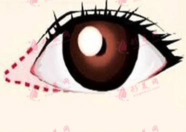 開眼角 開眼角