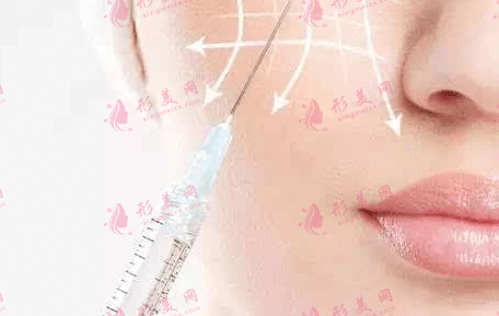 玻尿酸注射 玻尿酸注射