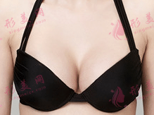 復(fù)合隆胸 復(fù)合隆胸