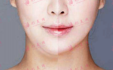 面部吸脂 面部吸脂
