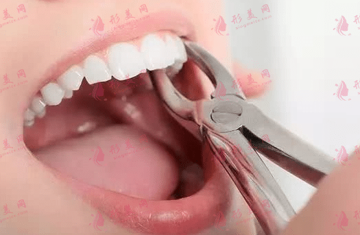 拔牙 拔牙