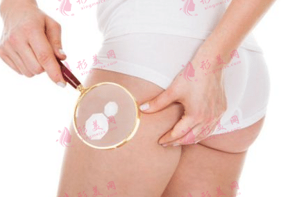 大腿吸脂 大腿吸脂