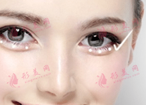 填充臥蠶 填充臥蠶