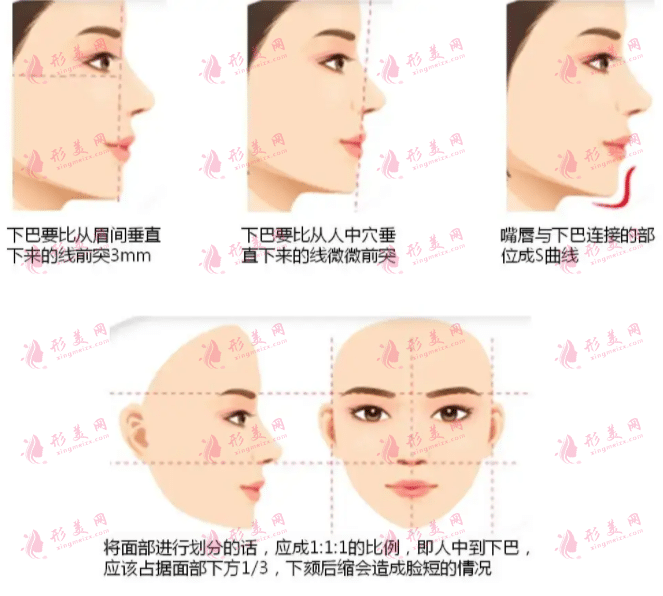 墊下巴后正常笑要多久？多久能完全恢復(fù)？