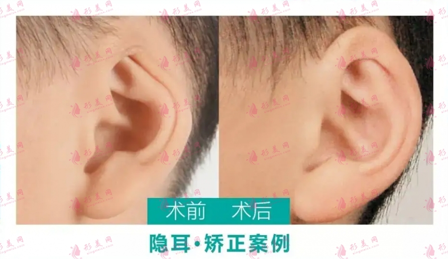山東省立醫(yī)院整形科小耳畸形矯正多少錢 適應(yīng)年齡是多大